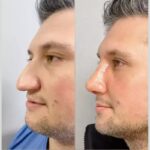 male rhinoplasty