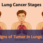 Signs of Tumor in Lungs