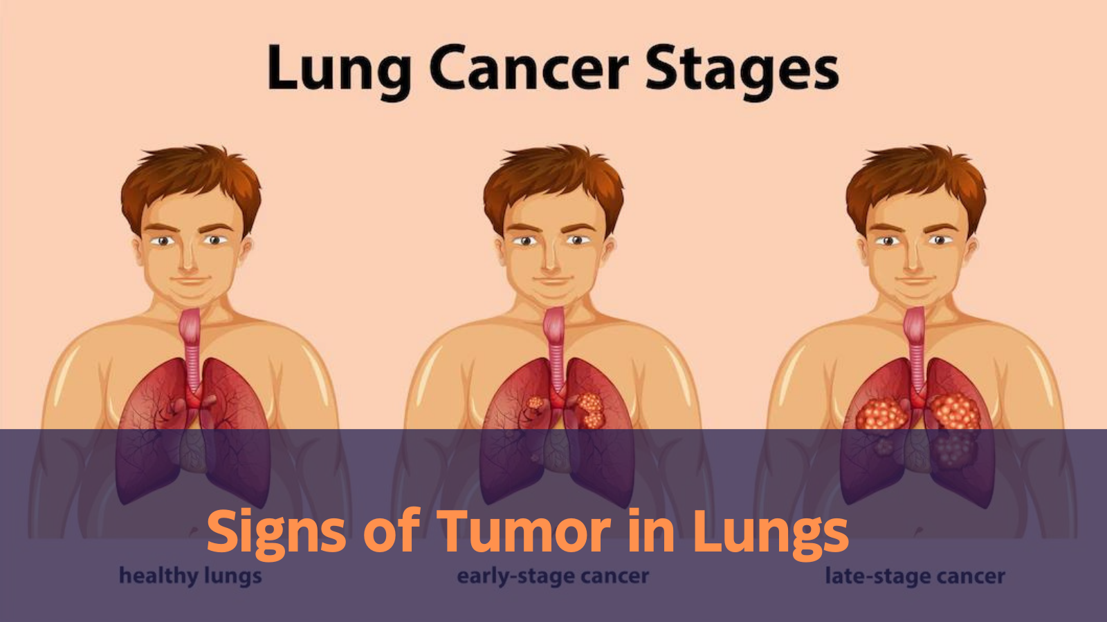 Signs of Tumor in Lungs